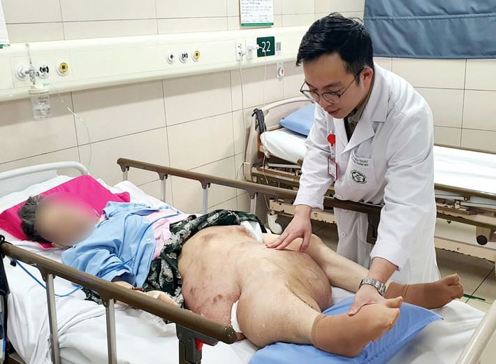 Căn bệnh u xơ thần kinh hiếm gặp khiến người bệnh mắc khối u khổng lồ ở chân phải