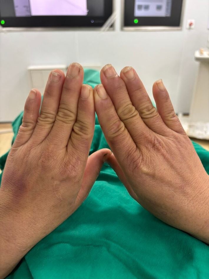 Căn bệnh lạ khiến người phụ nữ đau đớn mỗi khi chạm tay vào nước